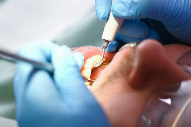 Best Emergency Root Canal Treatment in Friendly, MD
